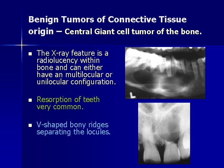 Benign Tumors of Connective Tissue origin – Central Giant cell tumor of the bone.