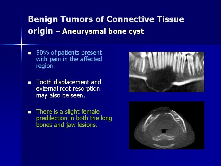 Benign Tumors of Connective Tissue origin – Aneurysmal bone cyst n 50% of patients