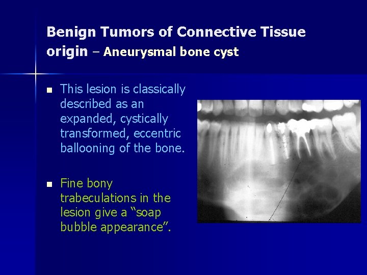 Benign Tumors of Connective Tissue origin – Aneurysmal bone cyst n This lesion is