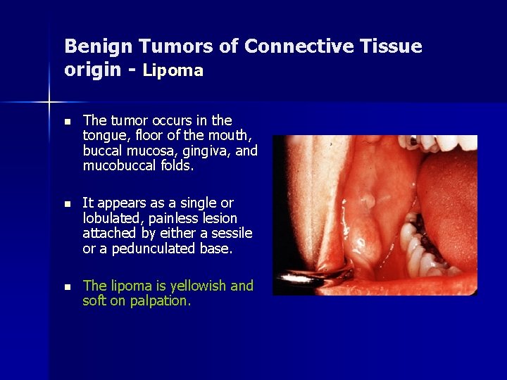 Benign Tumors of Connective Tissue origin - Lipoma n The tumor occurs in the