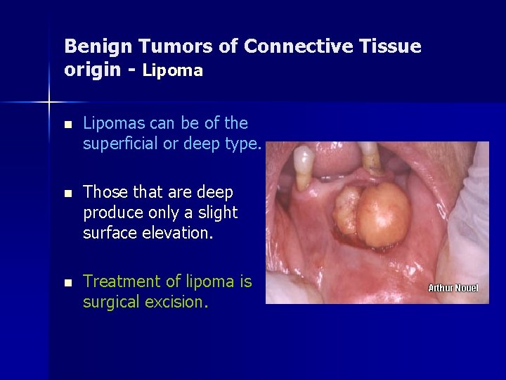 Benign Tumors of Connective Tissue origin - Lipoma n Lipomas can be of the