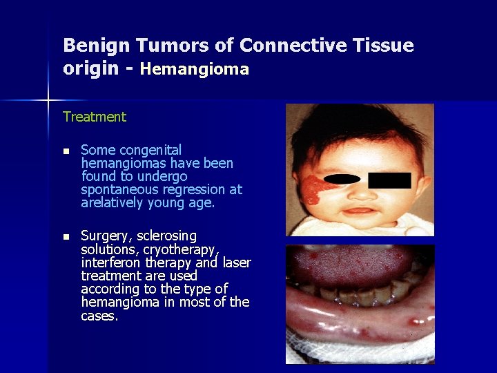 Benign Tumors of Connective Tissue origin - Hemangioma Treatment n Some congenital hemangiomas have