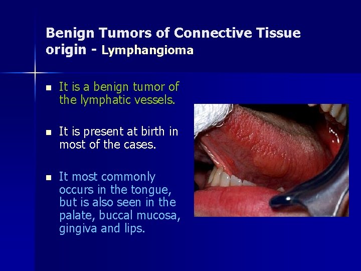 Benign Tumors of Connective Tissue origin - Lymphangioma n It is a benign tumor