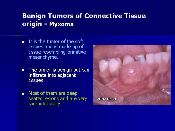 Benign Tumors of Connective Tissue origin - Myxoma n It is the tumor of