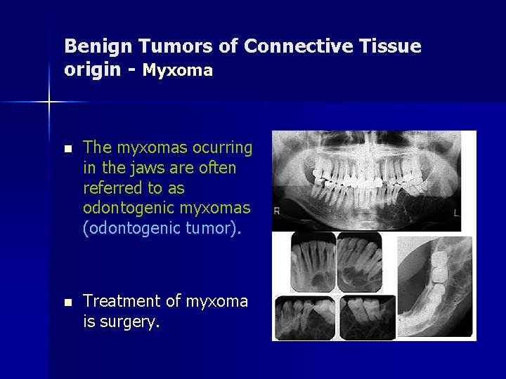 Benign Tumors of Connective Tissue origin - Myxoma n The myxomas ocurring in the