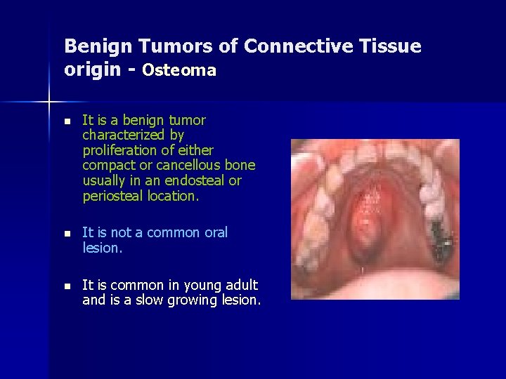 Benign Tumors of Connective Tissue origin - Osteoma n It is a benign tumor