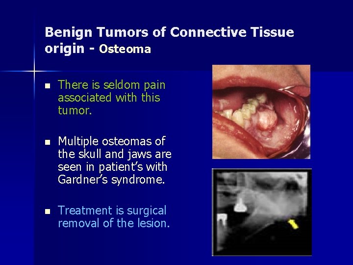 Benign Tumors of Connective Tissue origin - Osteoma n There is seldom pain associated