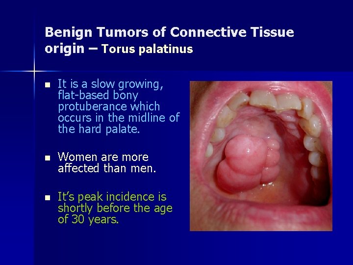 Benign Tumors of Connective Tissue origin – Torus palatinus n It is a slow