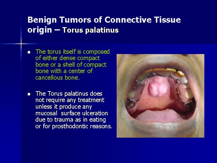 Benign Tumors of Connective Tissue origin – Torus palatinus n The torus itself is