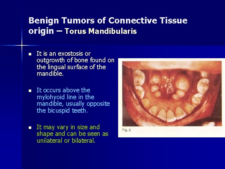 Benign Tumors of Connective Tissue origin – Torus Mandibularis n It is an exostosis