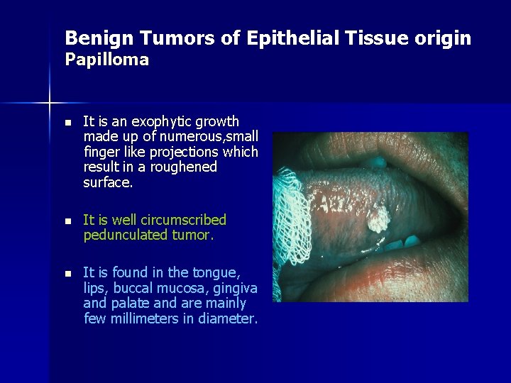 Benign Tumors of Epithelial Tissue origin Papilloma n It is an exophytic growth made