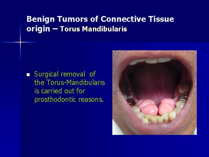 Benign Tumors of Connective Tissue origin – Torus Mandibularis n Surgical removal of the