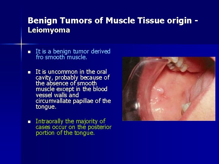 Benign Tumors of Muscle Tissue origin Leiomyoma n It is a benign tumor derived