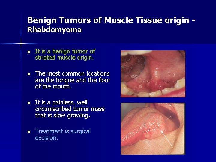 Benign Tumors of Muscle Tissue origin Rhabdomyoma n It is a benign tumor of