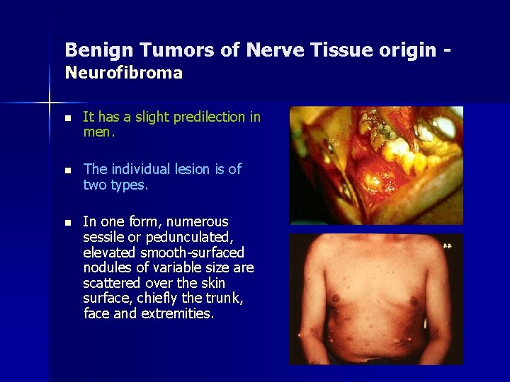 Benign Tumors of Nerve Tissue origin Neurofibroma n It has a slight predilection in