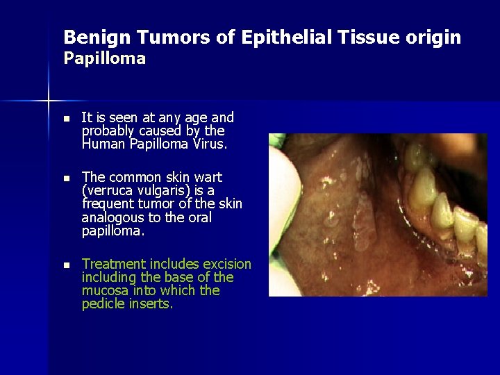 Benign Tumors of Epithelial Tissue origin Papilloma n It is seen at any age