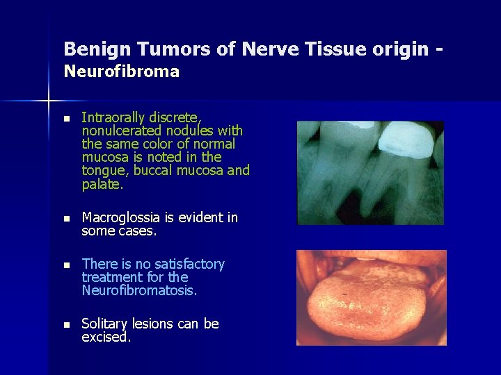 Benign Tumors of Nerve Tissue origin Neurofibroma n Intraorally discrete, nonulcerated nodules with the
