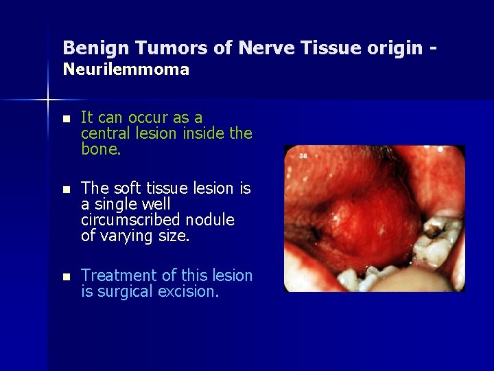 Benign Tumors of Nerve Tissue origin Neurilemmoma n It can occur as a central