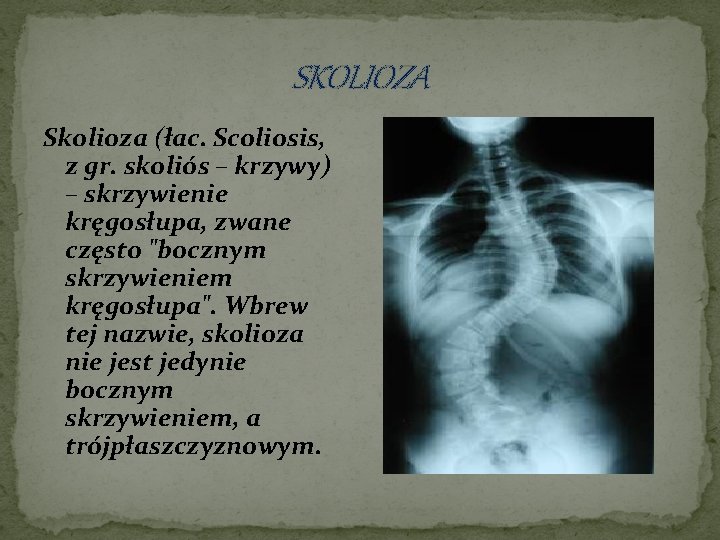 SKOLIOZA Skolioza (łac. Scoliosis, z gr. skoliós – krzywy) – skrzywienie kręgosłupa, zwane często