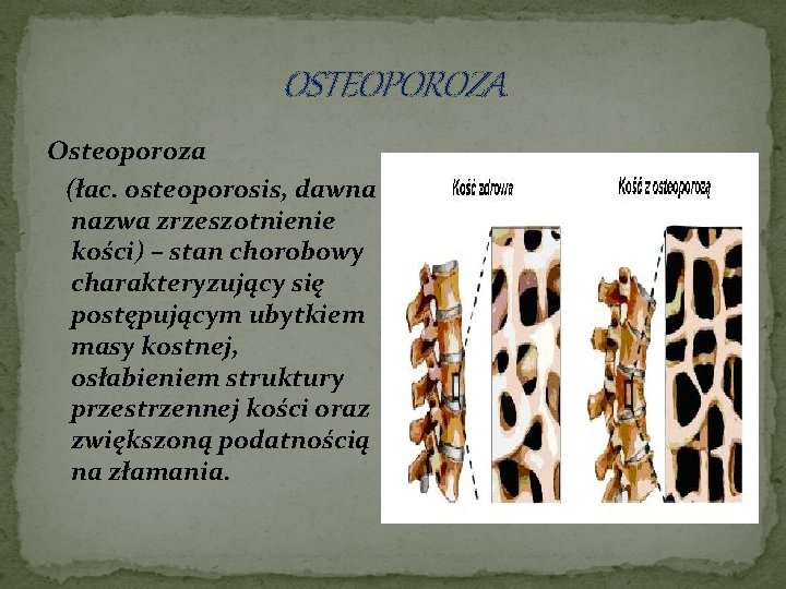 OSTEOPOROZA Osteoporoza (łac. osteoporosis, dawna nazwa zrzeszotnienie kości) – stan chorobowy charakteryzujący się postępującym