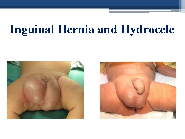 Inguinal Hernia and Hydrocele 