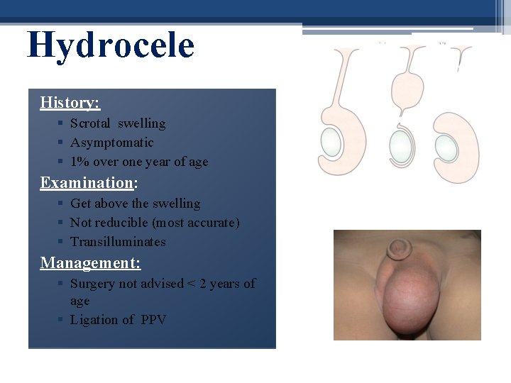 Hydrocele History: § Scrotal swelling § Asymptomatic § 1% over one year of age