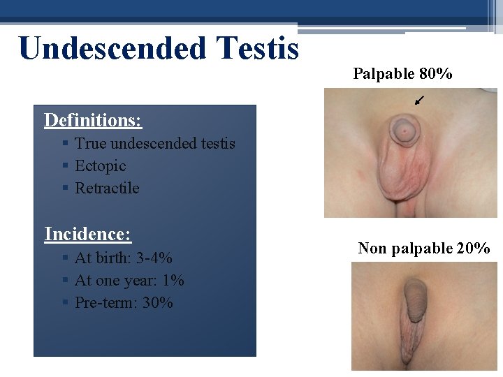 Undescended Testis Palpable 80% Definitions: § True undescended testis § Ectopic § Retractile Incidence: