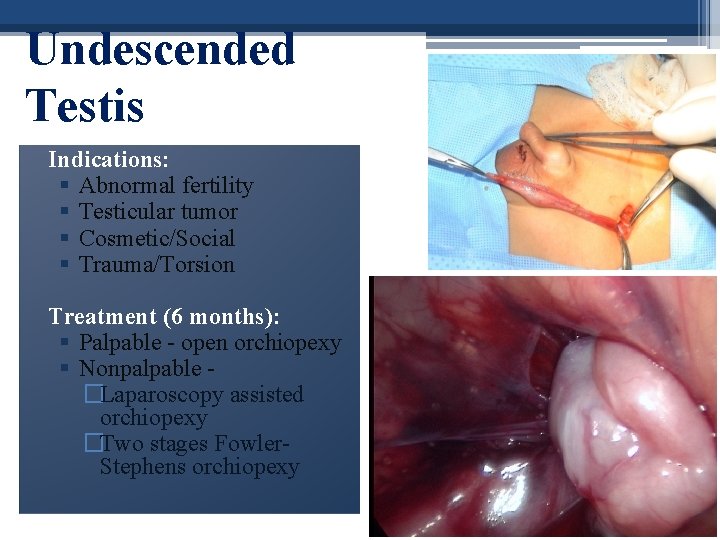 Undescended Testis Indications: § Abnormal fertility § Testicular tumor § Cosmetic/Social § Trauma/Torsion Treatment