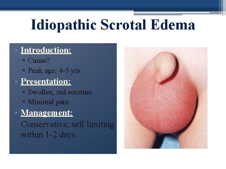 Idiopathic Scrotal Edema • Introduction: § Cause? § Peak age: 4 -5 yrs •