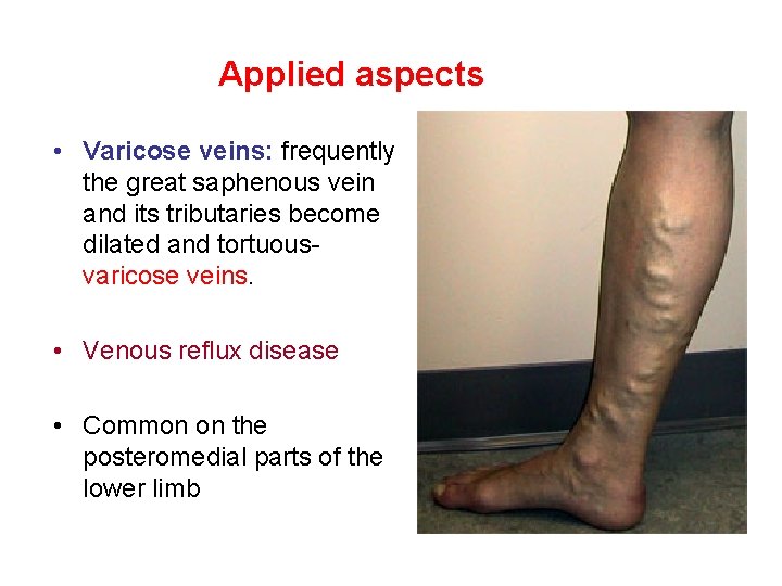 Applied aspects • Varicose veins: frequently the great saphenous vein and its tributaries become