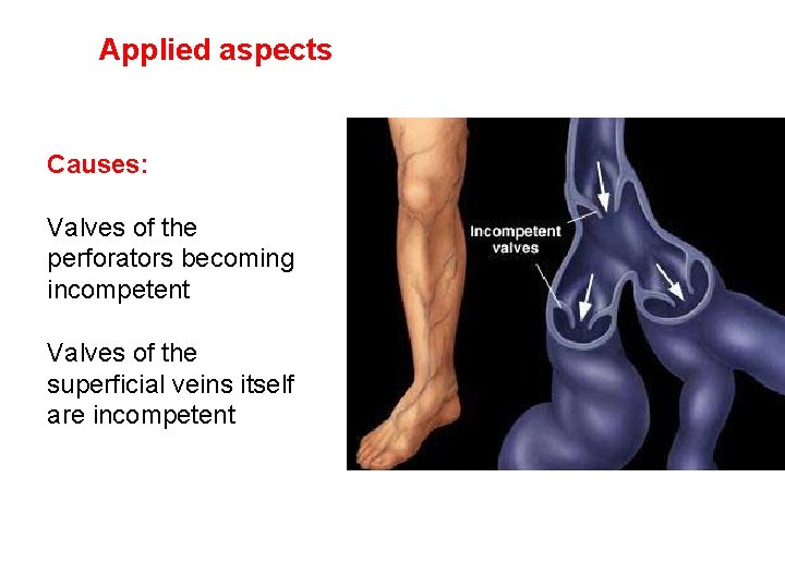 Applied aspects Causes: Valves of the perforators becoming incompetent Valves of the superficial veins