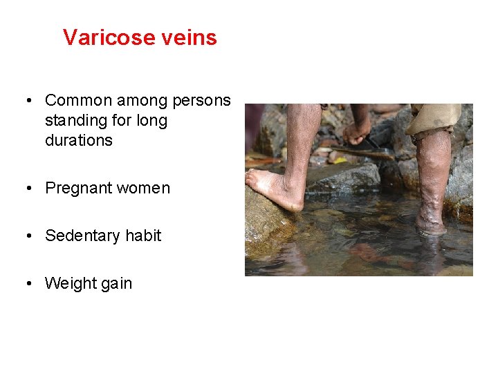 Varicose veins • Common among persons standing for long durations • Pregnant women •