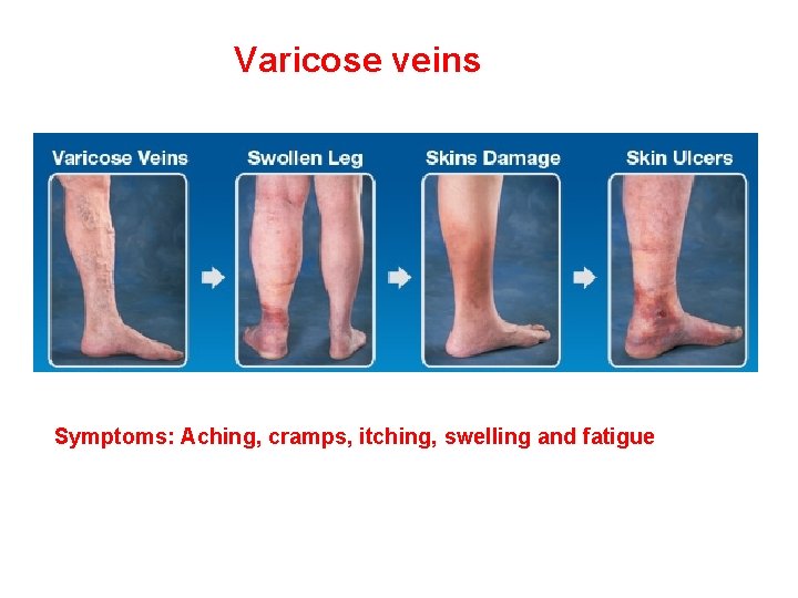 Varicose veins Symptoms: Aching, cramps, itching, swelling and fatigue 