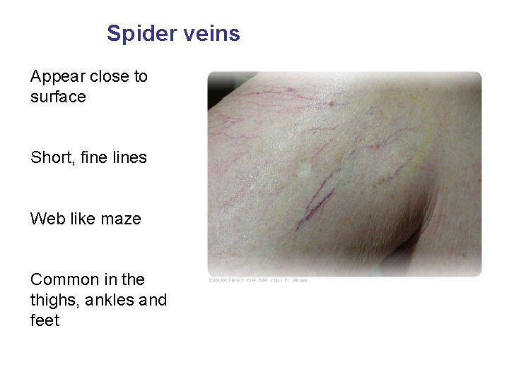 Spider veins Appear close to surface Short, fine lines Web like maze Common in