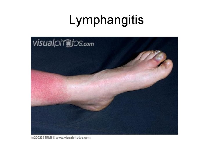 Lymphangitis 