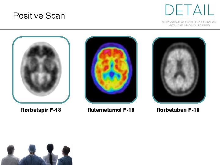 Positive Scan florbetapir F-18 Positive Scan flutemetamol F-18 florbetaben F-18 
