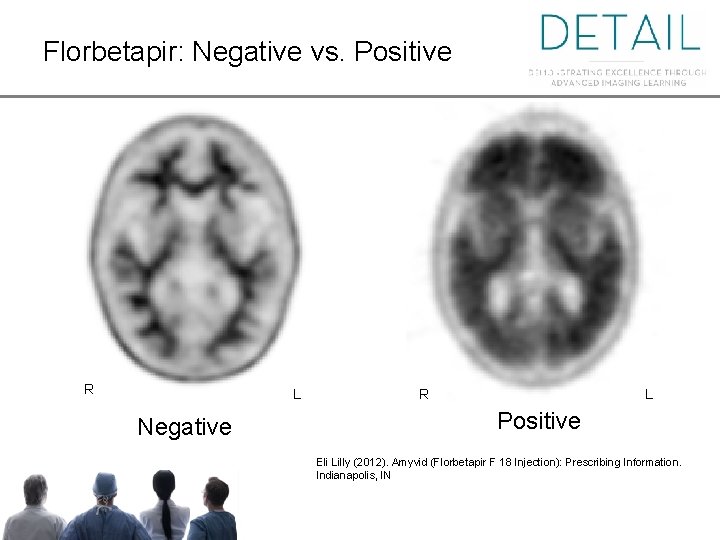 Florbetapir: Negative vs. Positive Florbetapir: Negative vs. . Positive R L Negative R L