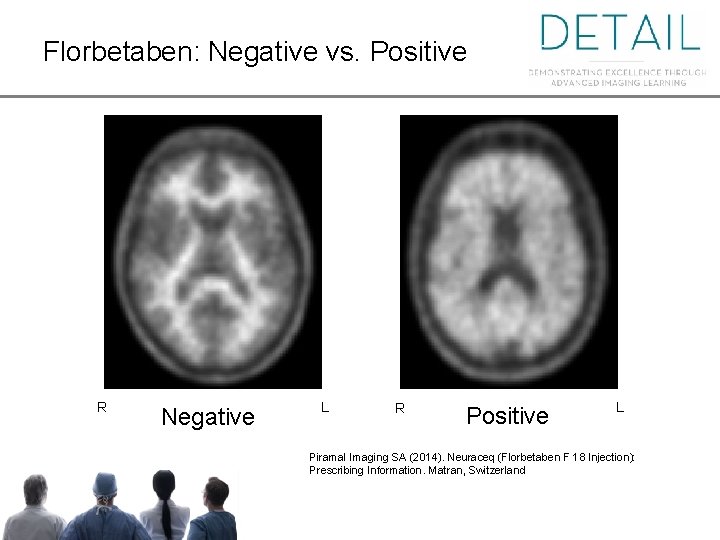 Florbetaben: Negative vs. Positive Florbetaben: Negative vs. . Positive R R Negative L R