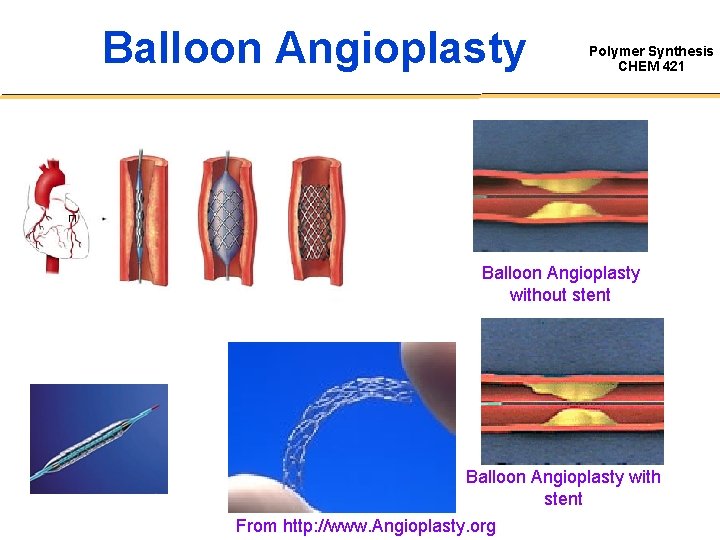 Balloon Angioplasty Polymer Synthesis CHEM 421 Balloon Angioplasty without stent Balloon Angioplasty with stent