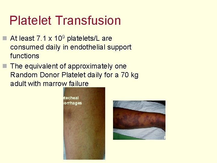 Platelet Transfusion n At least 7. 1 x 109 platelets/L are consumed daily in