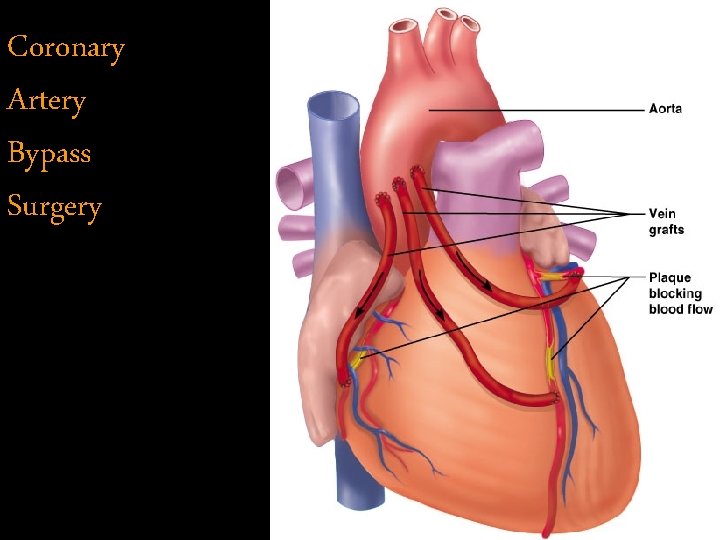 Coronary Artery Bypass Surgery 
