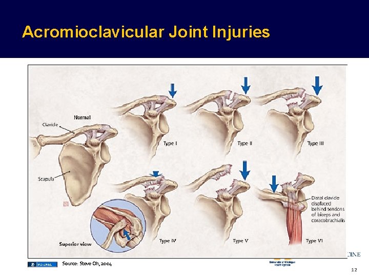Acromioclavicular Joint Injuries Source: Steve Oh, 2004 12  Acromioclavicular Joint Injuries Source: Steve Oh, 2004 12