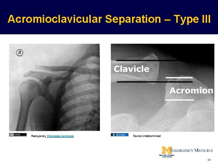 Acromioclavicular Separation – Type III Root 4(one), Wikimedia Commons Source Undetermined 14  Acromioclavicular Separation – Type III Root 4(one), Wikimedia Commons Source Undetermined 14