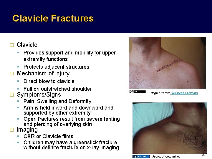 Clavicle Fractures � Clavicle Provides support and mobility for upper extremity functions Protects adjacent Clavicle Fractures � Clavicle Provides support and mobility for upper extremity functions Protects adjacent