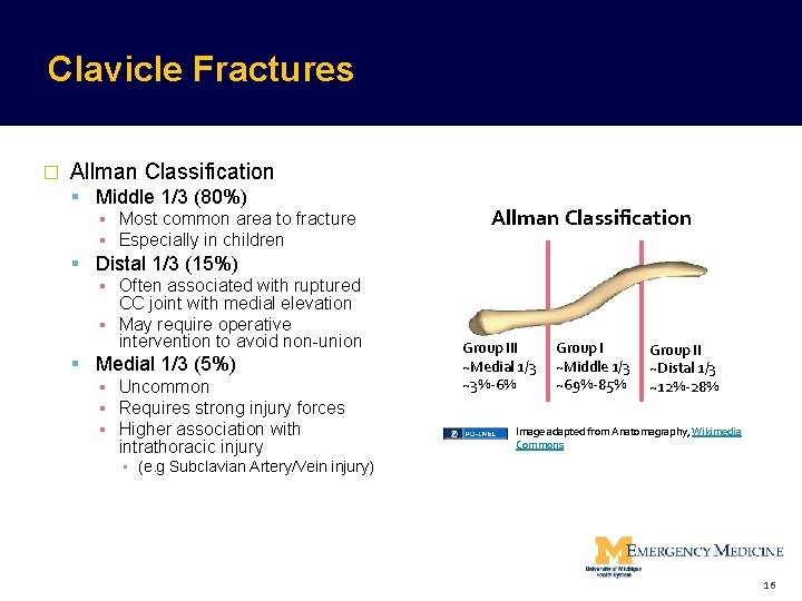 Clavicle Fractures � Allman Classification Middle 1/3 (80%) ▪ Most common area to fracture Clavicle Fractures � Allman Classification Middle 1/3 (80%) ▪ Most common area to fracture