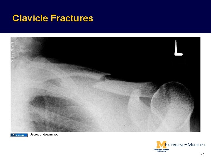 Clavicle Fractures Source Undetermined 17  Clavicle Fractures Source Undetermined 17