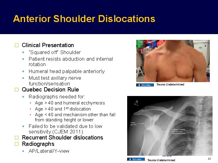 Anterior Shoulder Dislocations � Clinical Presentation “Squared off” Shoulder Patient resists abduction and internal Anterior Shoulder Dislocations � Clinical Presentation “Squared off” Shoulder Patient resists abduction and internal