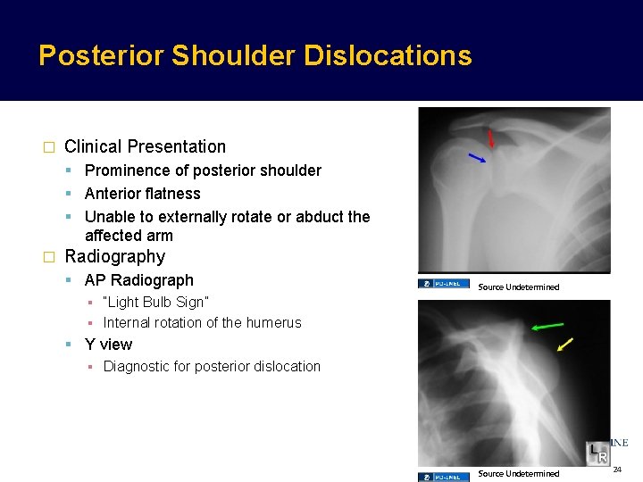 Posterior Shoulder Dislocations � Clinical Presentation Prominence of posterior shoulder Anterior flatness Unable to Posterior Shoulder Dislocations � Clinical Presentation Prominence of posterior shoulder Anterior flatness Unable to