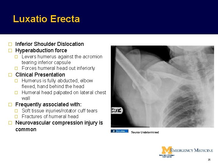 Luxatio Erecta � � Inferior Shoulder Dislocation Hyperabduction force Levers humerus against the acromion Luxatio Erecta � � Inferior Shoulder Dislocation Hyperabduction force Levers humerus against the acromion