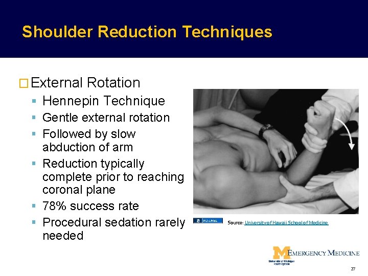 Shoulder Reduction Techniques � External Rotation Hennepin Technique Gentle external rotation Followed by slow Shoulder Reduction Techniques � External Rotation Hennepin Technique Gentle external rotation Followed by slow